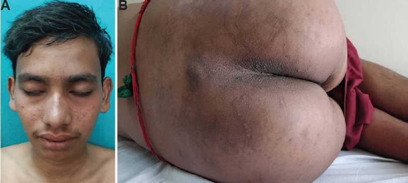 (A) Complete clearance of the periocular and perioral rash. Regain of normal hair colour and texture. (B) Complete clearance of the rash over the perianal and lower back region.